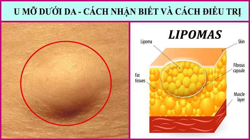 U Mỡ Dưới Da – Phát Hiện Và Điều Trị Như Thế Nào?