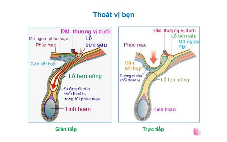 Thoát Vị Bẹn Có Nguy Hiểm Không? Khi Nào Cần Phẫu Thuật?